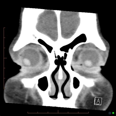 Orbital Dermoid Radiology Case