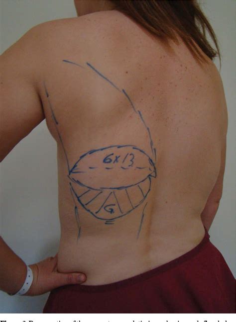Figure 2 From Use Of The Myocutaneous Latissimus Dorsi Flap With Fat