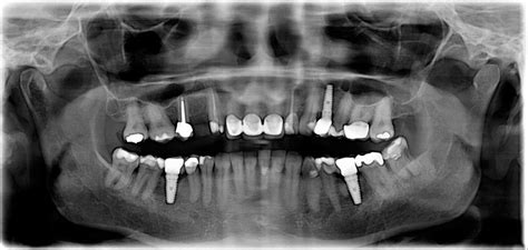 Planning Your Dental Implant Procedure Bolingbrook Il
