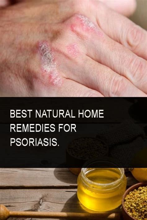 Best Natural Home Remedies For Psoriasis Psoriasis Psoriasis Home