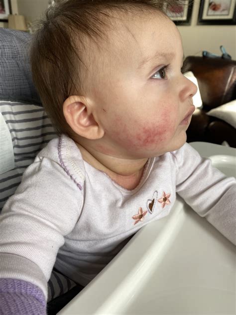 How This Mom Fought Her Babys Eczema And Won The Busy Mom Blog