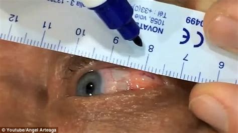 Video Shows An Ophthalmologist Removing Pus From Eyeball Daily Mail