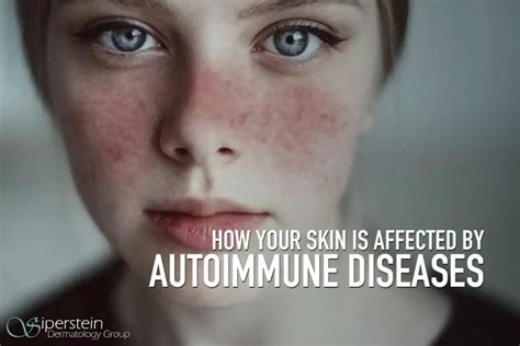The Link Between Autoimmune Diseases And Your Skin