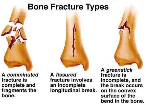 Compound Bone Fractures And Related Health Issues Bones Accident