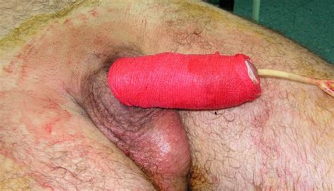 Broken Penis Images Xxx Suck Cock