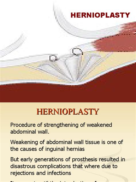 Hernioplasty Pdf Surgery Clinical Medicine