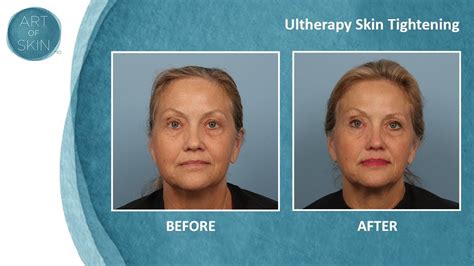 Ultherapy Ultrasound Painless Facelift Dr Melanie Palm San Diego