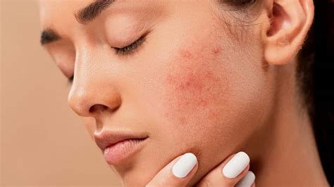 How To Clear Acne Scars Naturally And Organically Reenasidhu