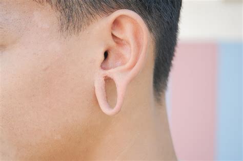 Bay Area Earlobe Repair Stretched Ears Fix Stretched Earlobes