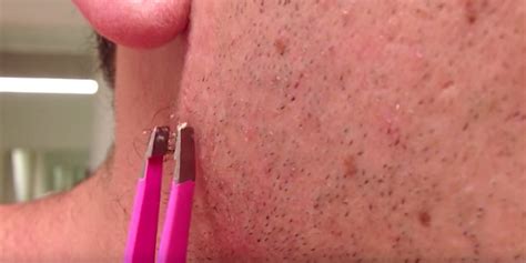 Video The Most Watched Ingrown Hair Removal On Youtube