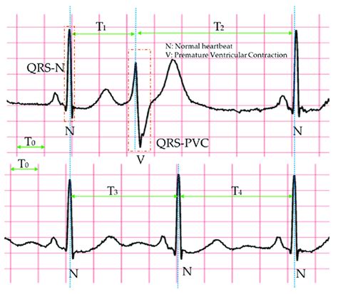 Premature Ventricular Contractions