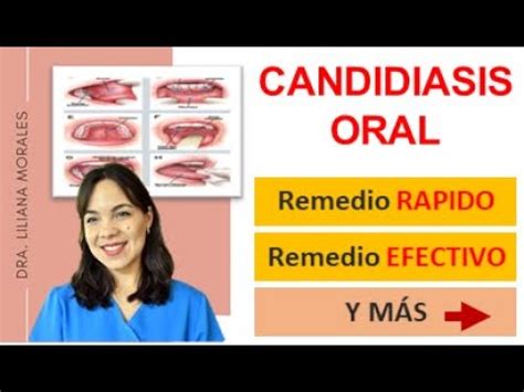 3 Remedios naturales para CANDIDIASIS orales Cándida Albicans causas