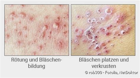 Even after you've gotten chickenpox as a child, the. Gürtelrose (Herpes Zoster): Ansteckung, Symptome ...