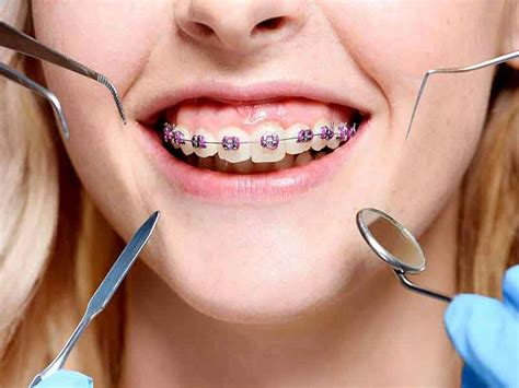 Orthodontics Types Of Dental Treatment For Relief Onlymyhealth