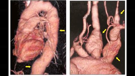 Arteritis De Takayasu Youtube