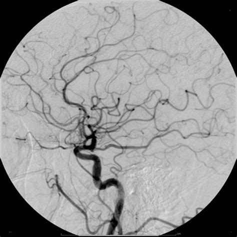 Cerebral Angiography Causes Symptoms Treatment Cerebral Angiography