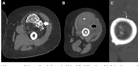 Figure 2 From Liposarcoma Of The Thigh With Mixed Calcification And