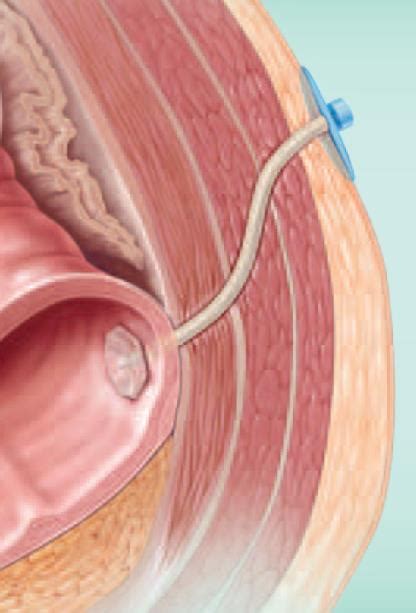 Enterocutaneous Fistula Plug Memphis Vascular Center