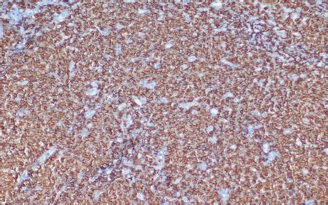 A Case Of Collision Tumor Of Malt Lymphoma And Poorly Differentiated