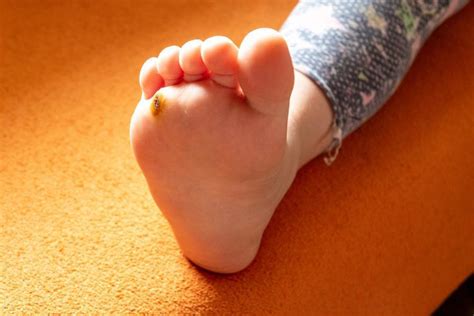Plantar Warts In Kids What You Need To Know North Central Texas Foot