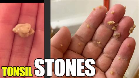 Tonsil Stones Largest Biggest And Massive Tonsil Stones Youtube