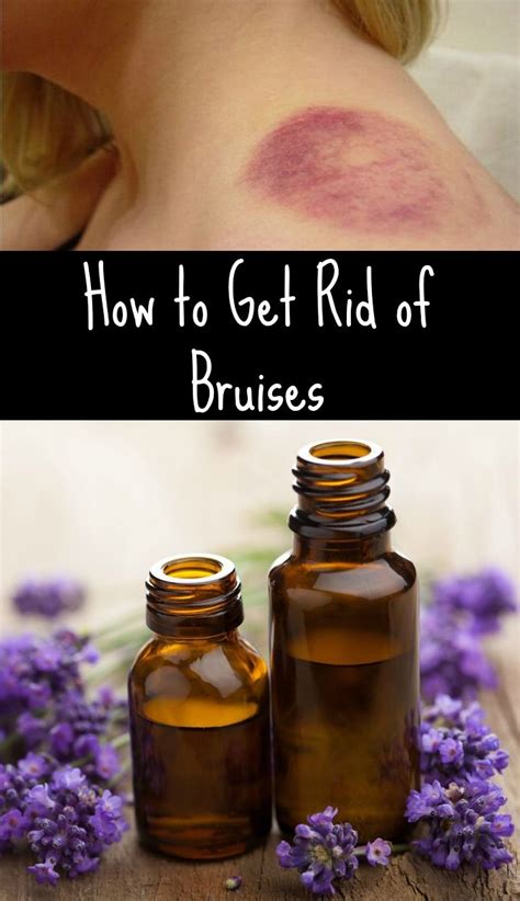 17 Home Remedies For How To Get Rid Of Bruises Remedies Heal Bruises