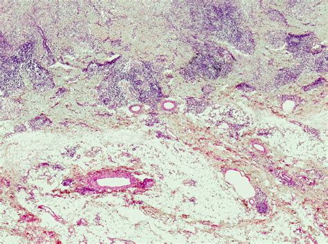 Lupus Vulgaris Skin Cancer Light Micrograph Stock Image C0517135