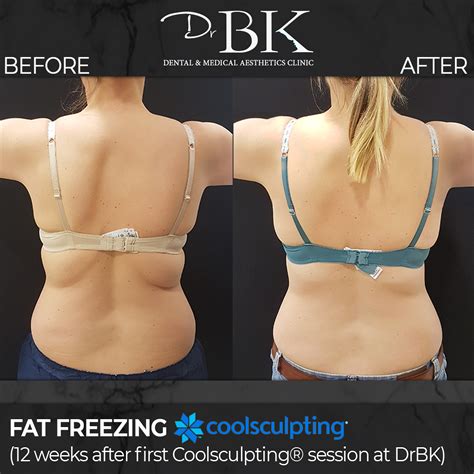 Coolsculpting® Fat Freezing Treatment Drbk Clinic In Reading