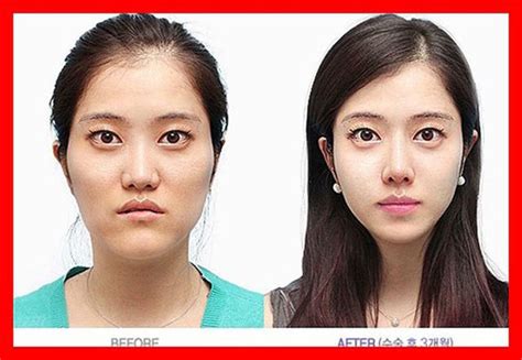 Before And After Photos Of Korean Plastic Surgery Part Pics