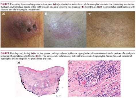 A Surprising Case Of Mycobacterium Avium Complex Skin Infection In An