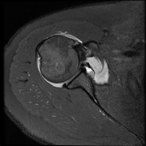 Radiology Cases Anterosuperior Labral Tear With Paralabral Cyst