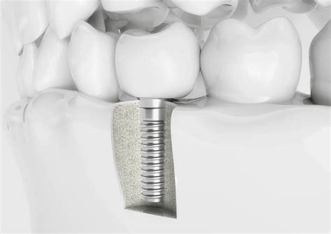Do I Need A Bone Graft Before Getting An Implant Board Certified