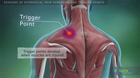 How Are Fibromyalgia And Myofascial Pain Syndrome Different