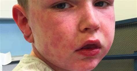 Boy 7 Allergic To Winter Breaks Out In Body Rash And Violently Vomits