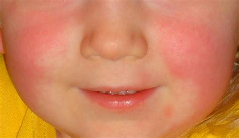 7 Common Causes Of Sinus Infections In Toddlers