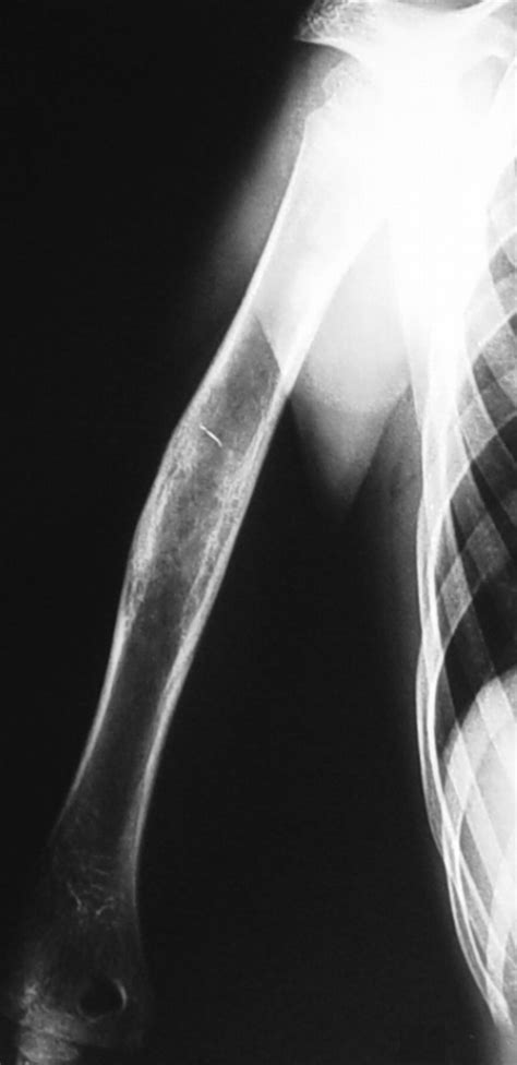 Treatment Of Aneurysmal Bone Cysts With Percutaneous Sclerotherapy