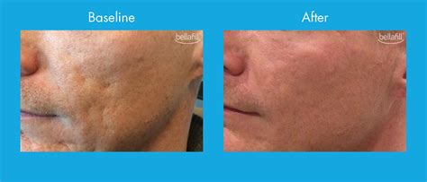 Bellafill Treatment For Acne Scarring In New Jersey Soma Skin And Laser