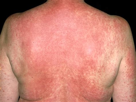 Can Metoprolol Cause Hives