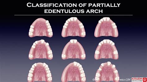 Classification Of Partially Edentulous Arch Youtube