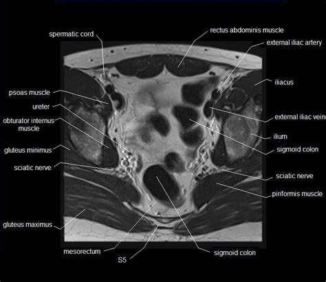 Not only mri pelvis muscle anatomy, you could also find another pics such as pelvic mri anatomy, female pelvic mri anatomy, female pelvis mri axial, pelvic muscles. mri hip anatomy - Google Search | Pelvis anatomy, Anatomy ...
