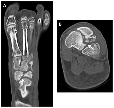 Computed Tomography Scans At The Time Of Presentation A Axial Image