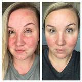 Photos of Skincare And Makeup For Rosacea