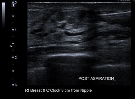 Simple Breast Cyst Radiology Case