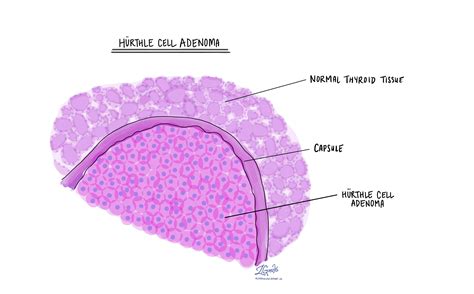 Hurthle Cell Adenoma Mypathologyreportca