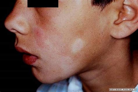 Boys and girls get it about equally as often. Pityriasis alba | Primary Care Dermatology Society | UK