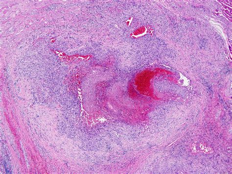 Pathology Outlines Epithelioid Sarcoma