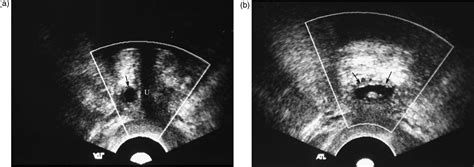 Intraoperative Translabial Ultrasound For Urethral Diverticula A Road
