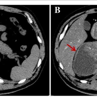 Abdominal Computed Tomography Ct Scan Revealed A Large Mass Arrow My