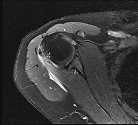 Calcific Tendinitis Of The Infraspinatus Tendon Radiology Case