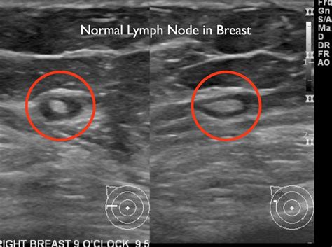 Lymph Node Biopsy Under Armpit Dailybasis